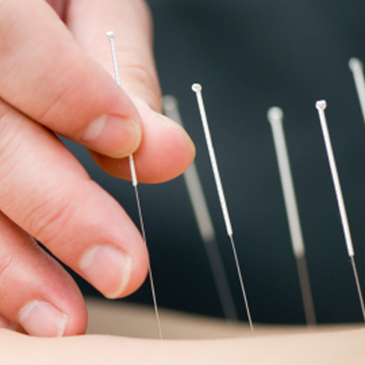 Acupuncture: What is The Point?